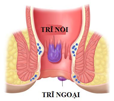 Bệnh-trĩ