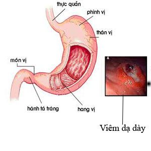 viêm-loét-dạ-dày