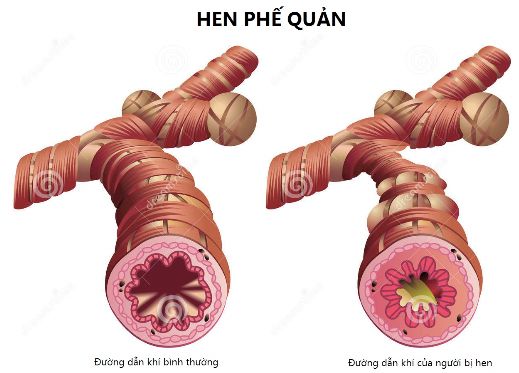 bệnh hen phế quản