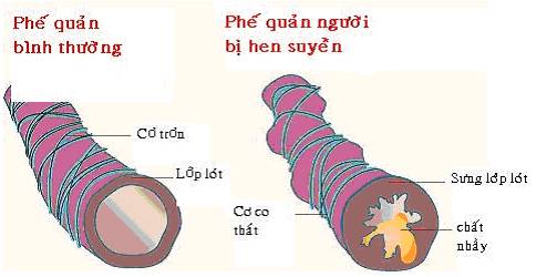 bệnh suyễn ở trẻ em