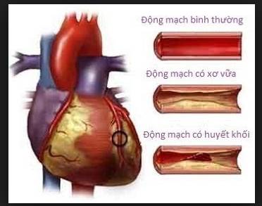 bệnh nhồi máu cơ tim là gì