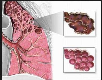 bệnh phổi đa nang - đa nang phế quản