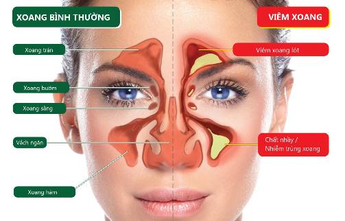 tổng quan về các bệnh viêm xoang