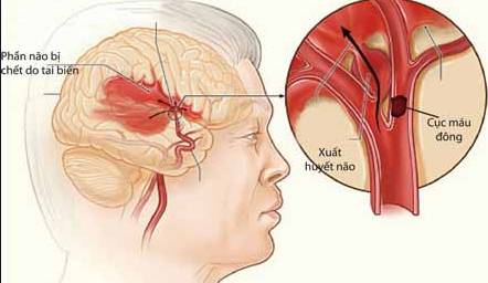 Bệnh tai biến xuất huyết não