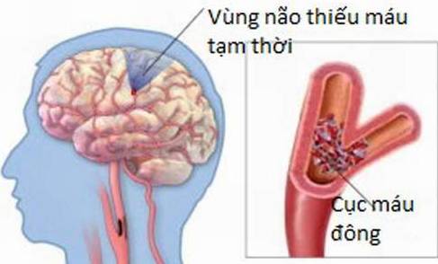 điều trị thiểu năng tuần hoàn não bằng oxy cao áp