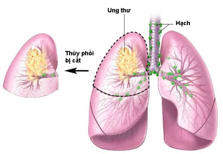 ung thư phổi là gì