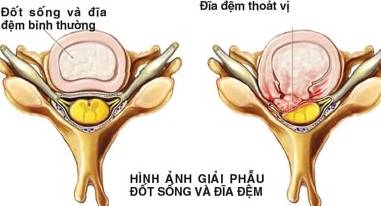 bệnh thoát vị đĩa đệm cột sống