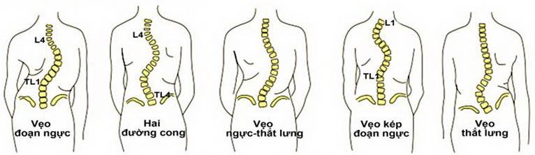 phòng ngừa vẹo cột sống cho trẻ em