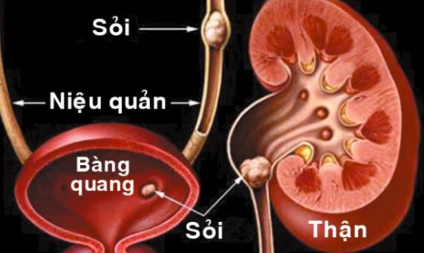 Bệnh sỏi thận có thẻ gây suy thận