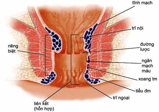 phòng ngừa bệnh trĩ