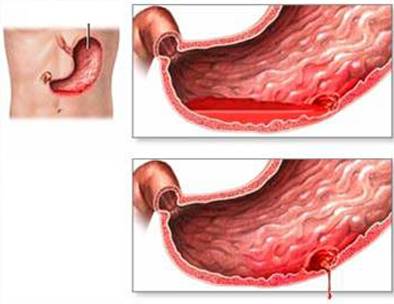chảy máu đường tiêu hóa