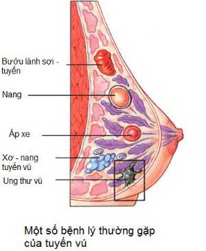 Những nguyên nhân gây xơ nang tuyến vú